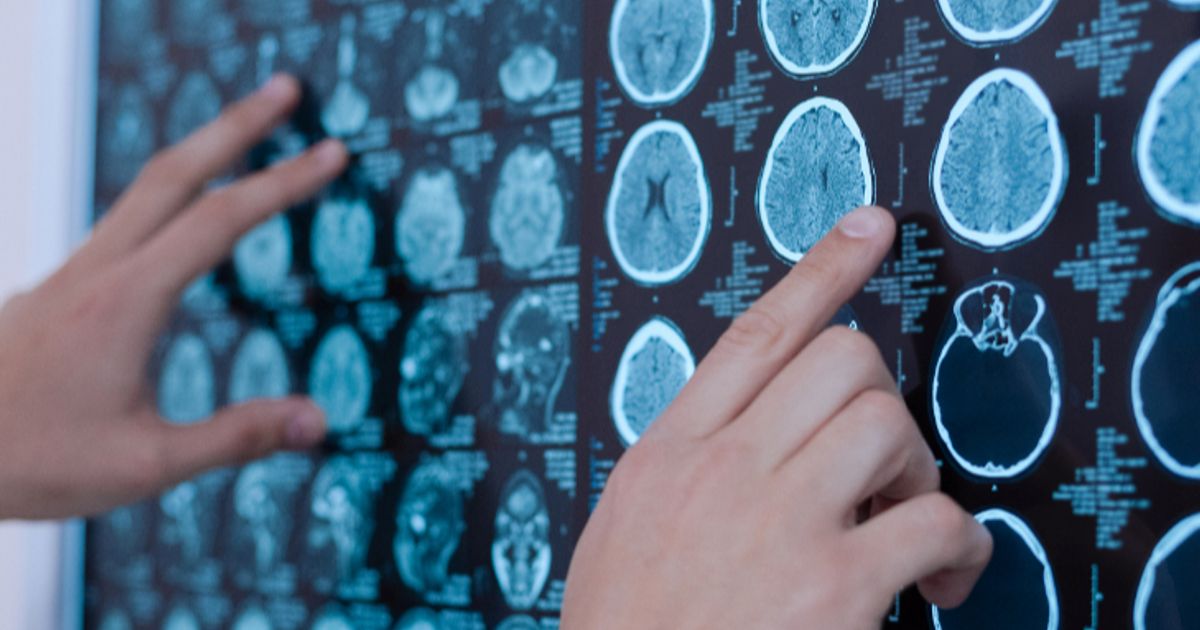 Noxopharm and UniSA receive Tour de Cure grant for brain cancer research - Vimarsana News