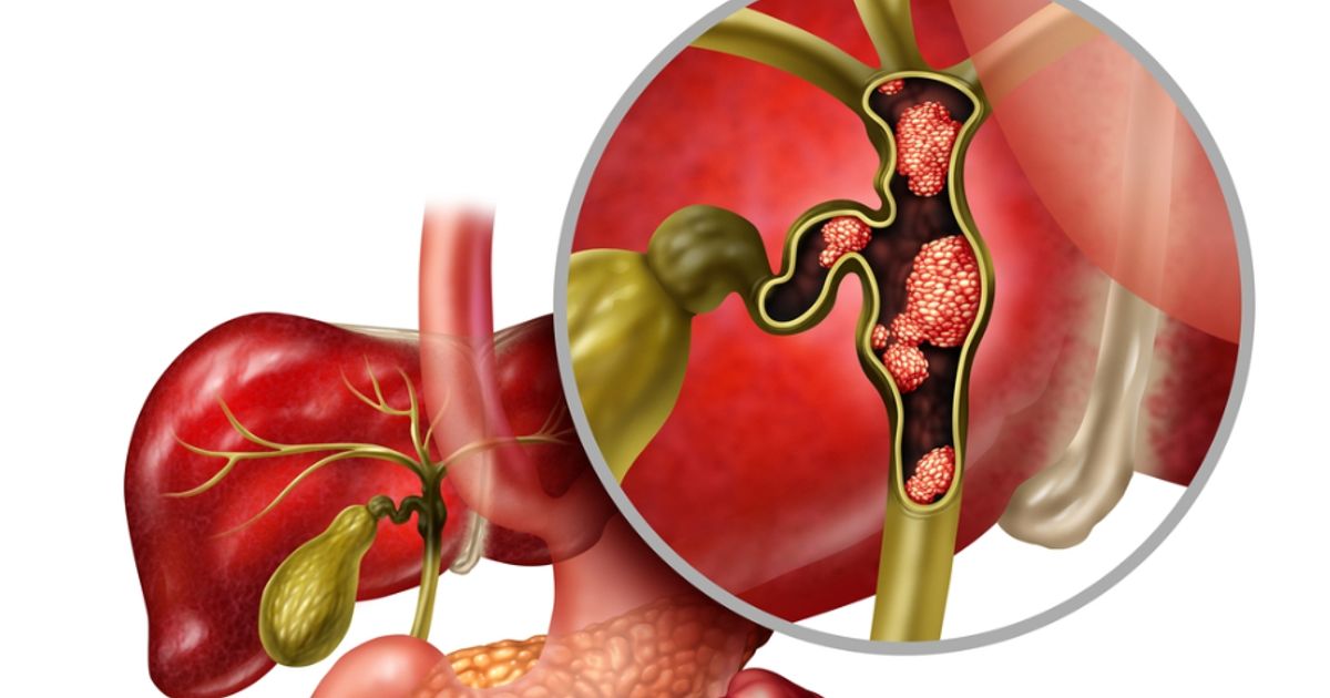 Lisata Therapeutics' certepetide receives Orphan Drug Designation for cholangiocarcinoma