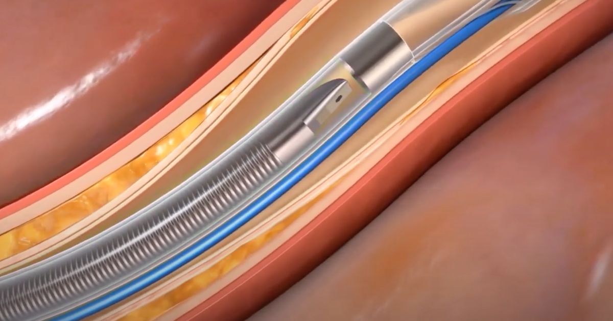 Conavi Medical Unveils Next-Gen Dual-Modality Catheter for Cardiac ...