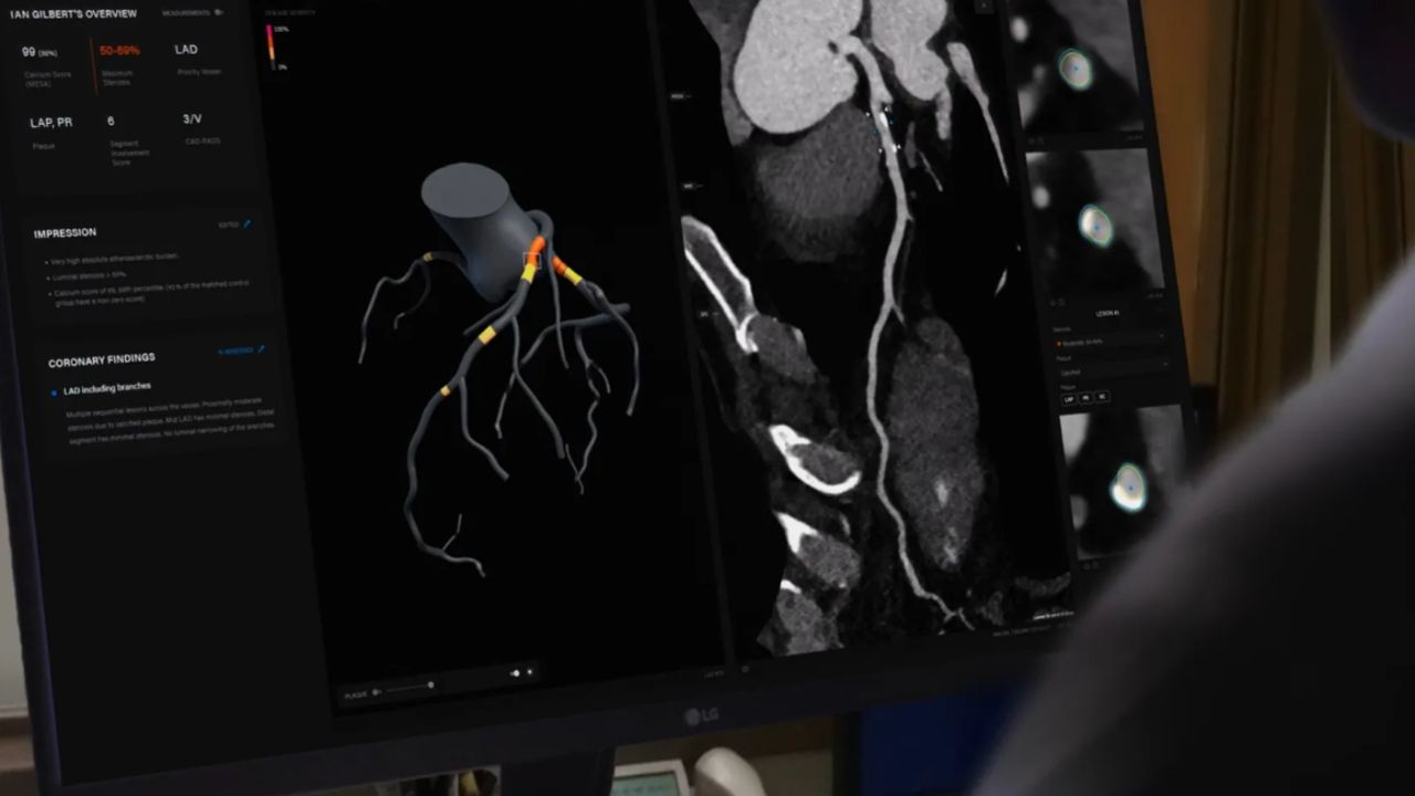 Artrya signs US$600,000 contract with Tanner Health, marks first US ...