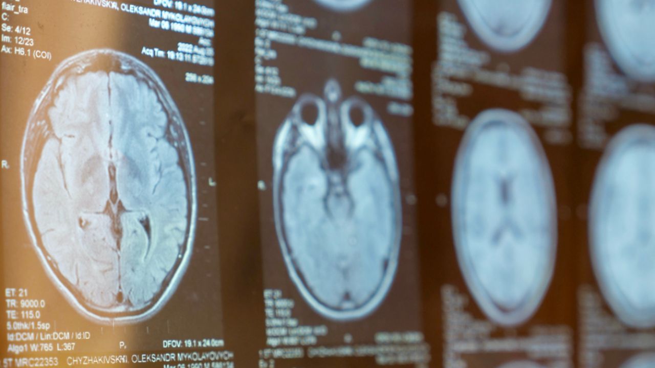 Immunic is aiming for a big breakthrough in the treatment of multiple ...