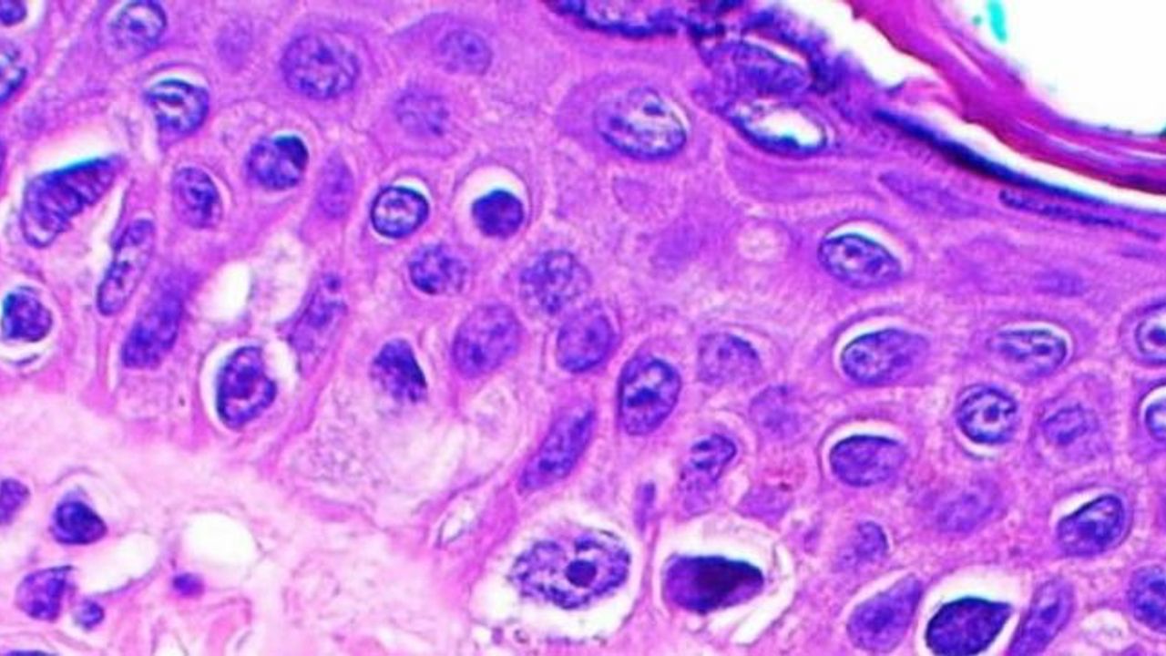 Medicus Pharma seeks orphan drug status for SkinJect in rare skin ...