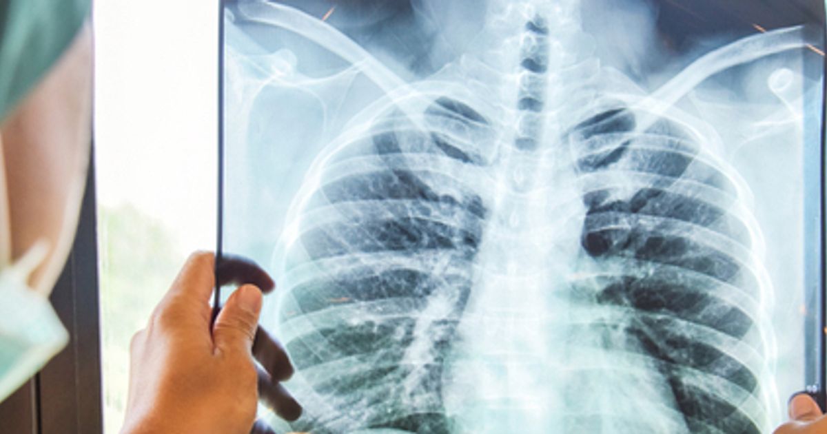 Tozorakimab trial success hands AstraZeneca a crucial edge in the...