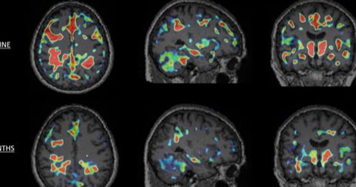 Tiziana Life Sciences Ltd finds promising indicator of MS treatment success - Vimarsana News