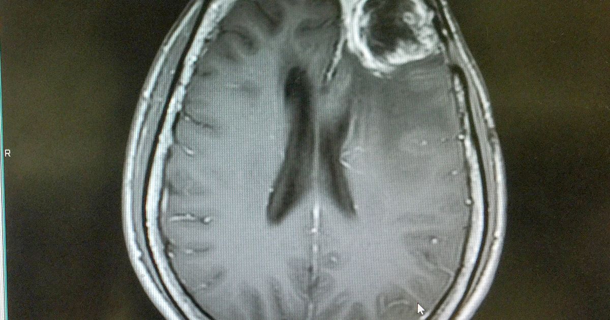 Evgen Pharma CMO highlights "very aggressive" disease on Glioblastoma Awareness Day - Vimarsana News