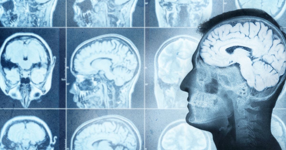 Immunic CSO hails "great" progress with MS program - Vimarsana News