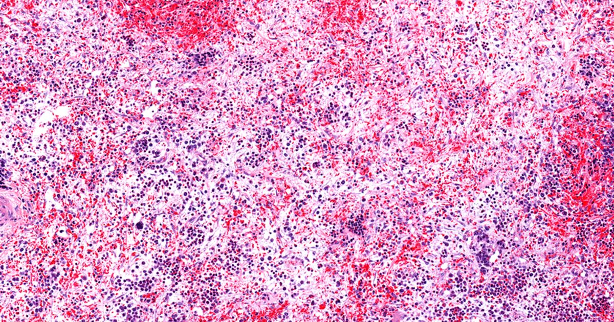 Syntara advances multinational study targeting rare bone marrow cancer myelofibrosis - Vimarsana News